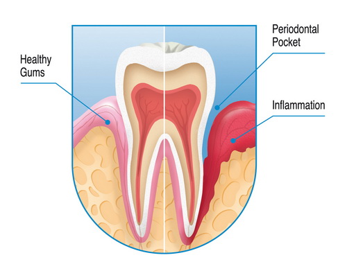 Periodontal Treatment and Esthetic gum surgery – Empress Dental Care Clinic